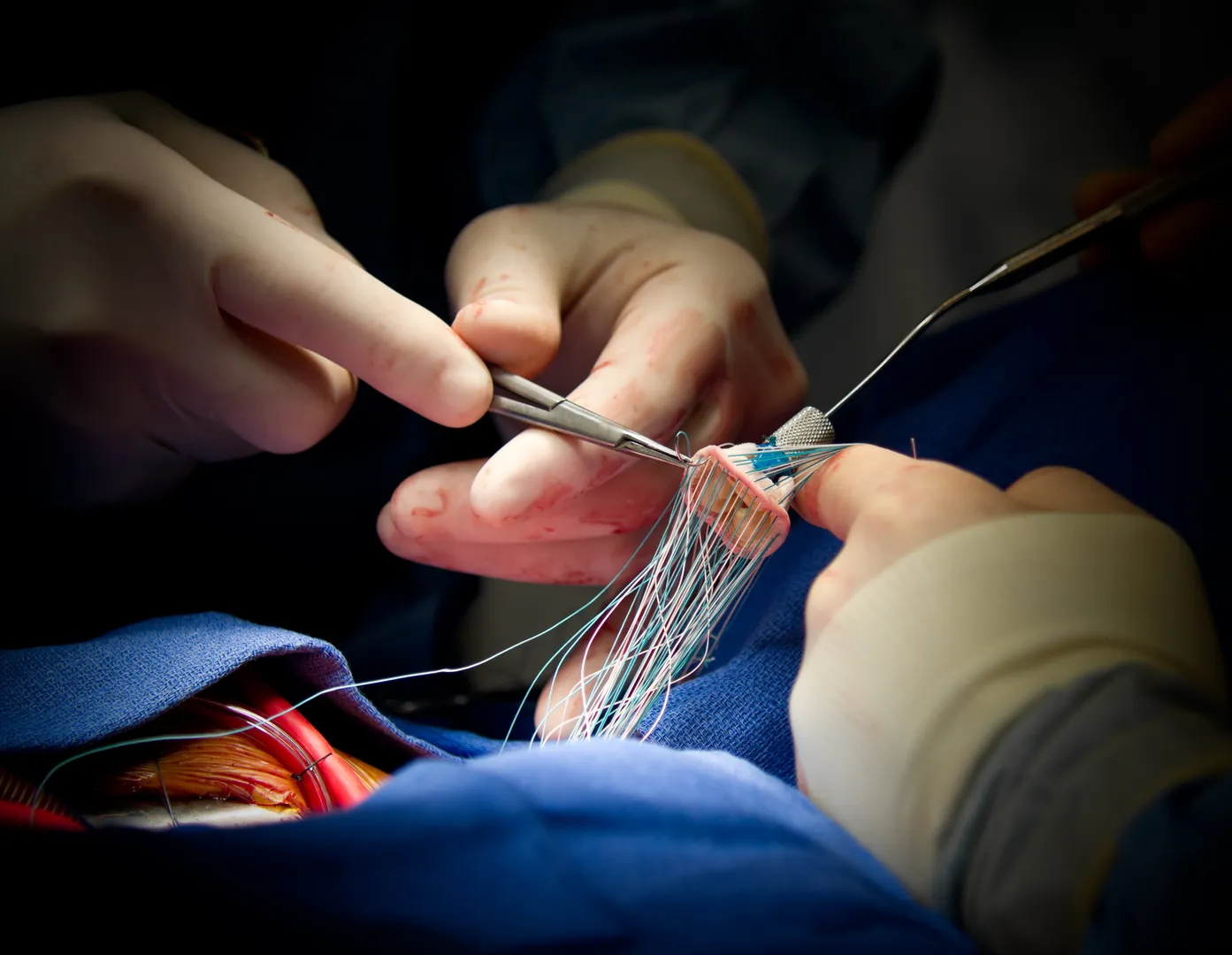 Heart Valve Surgery image 1